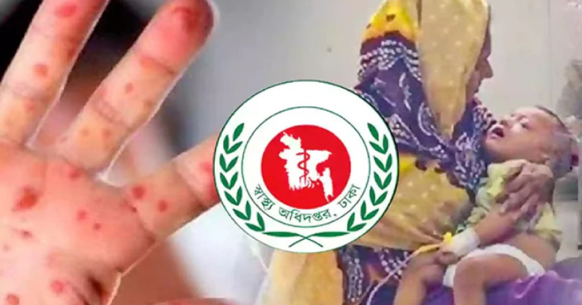 ২৪ ঘণ্টায় হামের উপসর্গ নিয়ে ১২ শিশুর মৃত্যু